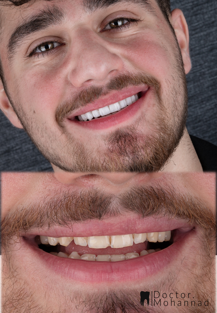 Composite Smile