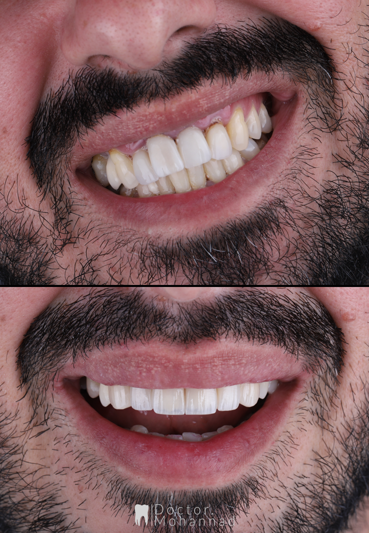Emax Veneers