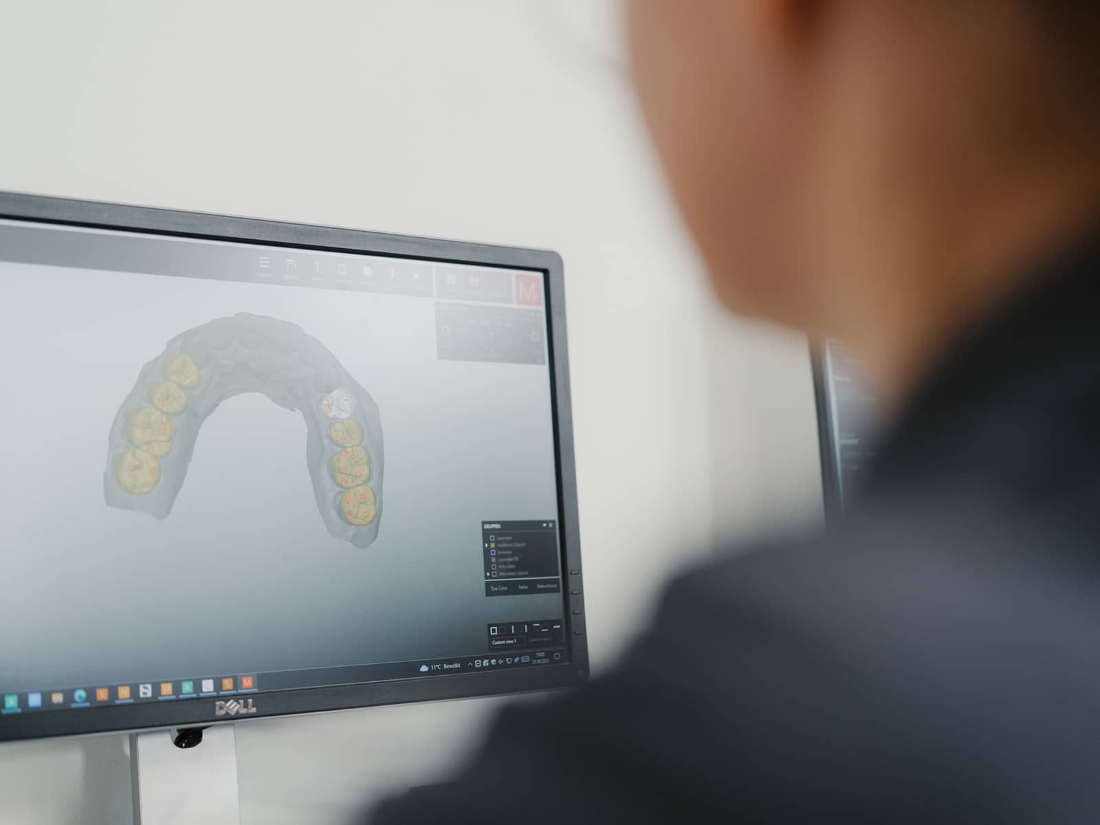 Digitale 3D-Planung des Kiefers für eine All-on-4 Implantat-Behandlung bei Q-Zahnärzte Freiburg – präzise computergestützte Implantologie