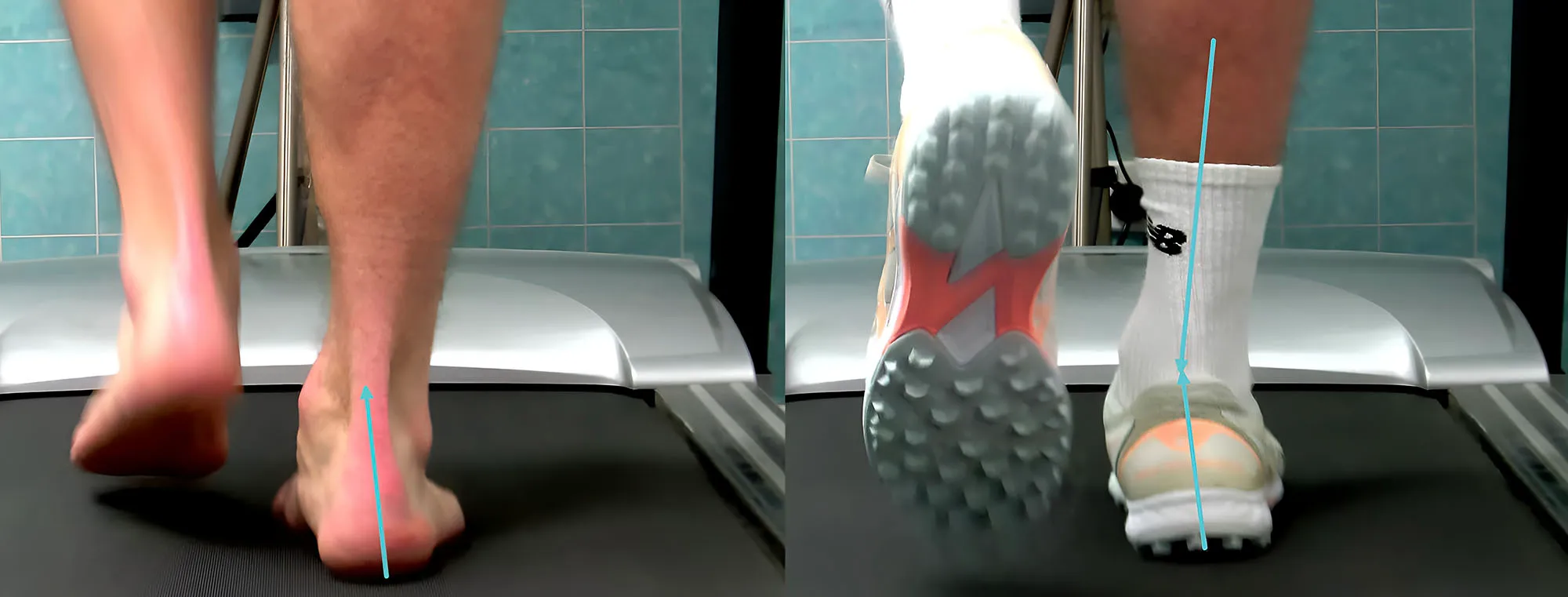 Comparison of a person's heels walking on a treadmill: barefoot pronation (left) vs. neutral alignment with shoes (right).
