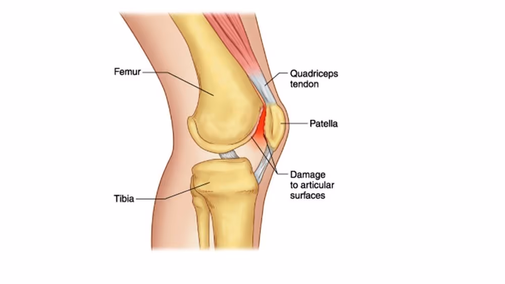 Patello femoral syndrome