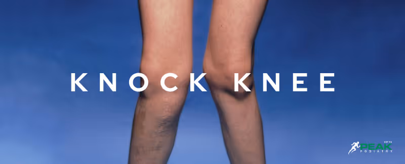 Knock Knees