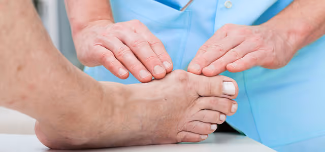  a close-up of a person's bare feet, focusing on bunions on the side of both feet near the base of the big toe. The skin around the bunions appears red and inflamed. The person's toes are slightly bent and overlapping