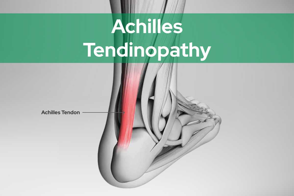 Achilles Tendinopathy