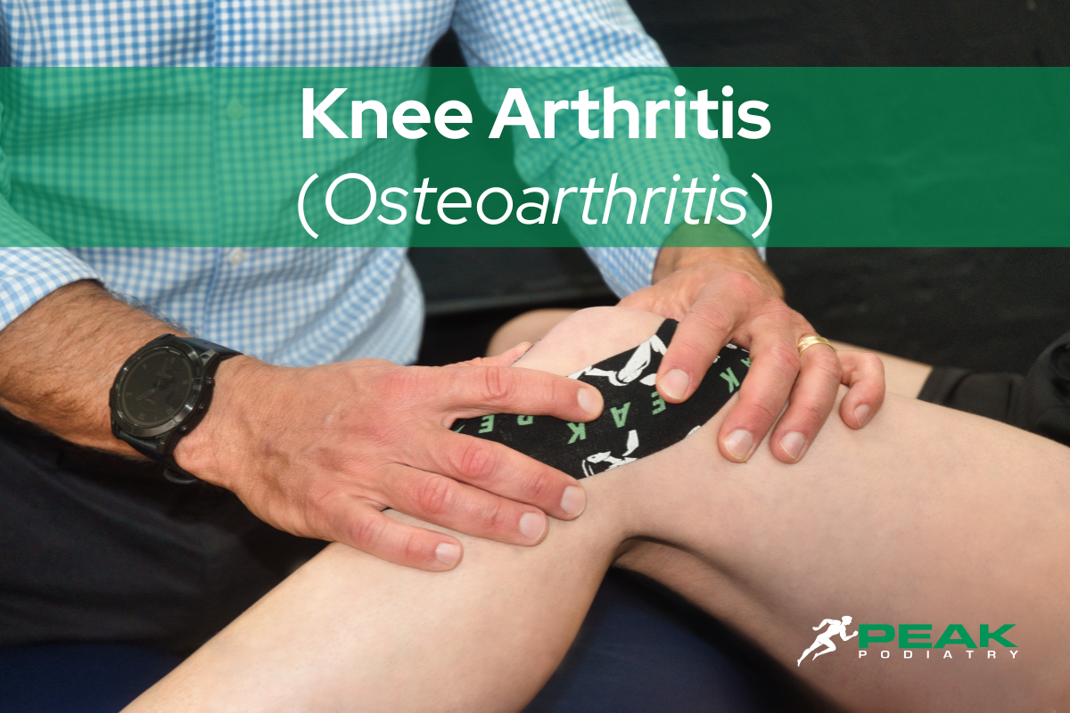 Knee Arthritis: Signs, Symptoms, Causes & Treatment