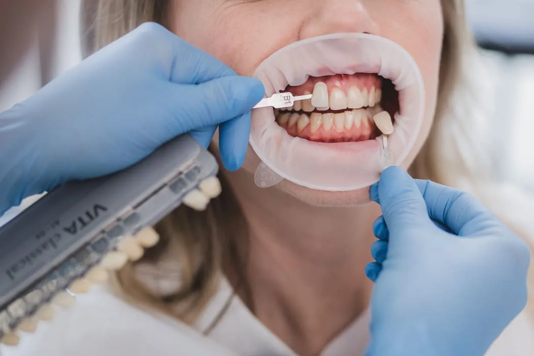 wybielanie-zebow-krakow-cena