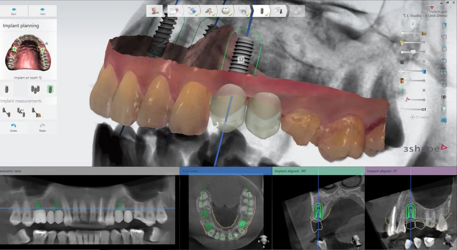 nawigacja-w-implantologii