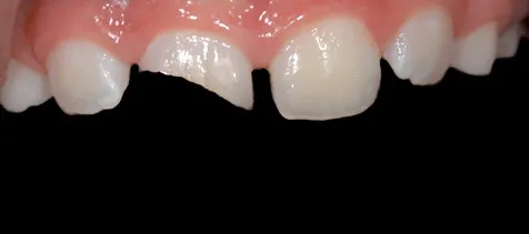 zlamany-zab-11-przed-rekonstrukcja-wichlinscy-stomatologia