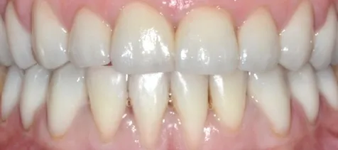 rekonstrukcja-uzebienia-korony-pelnoceramiczne-po-leczeniu-wichlinscy-stomatologia