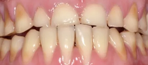 starte-i-zniszczone-zeby-erozja-przed-leczeniem-wichlinscy-stomatologia