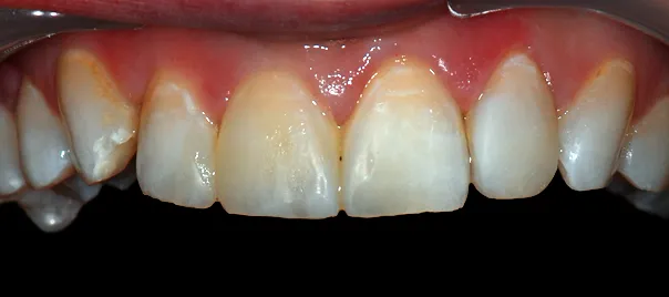 odbudowa-kompozytowa-zebow-12-22-po-urazie-wichlinscy-stomatologia