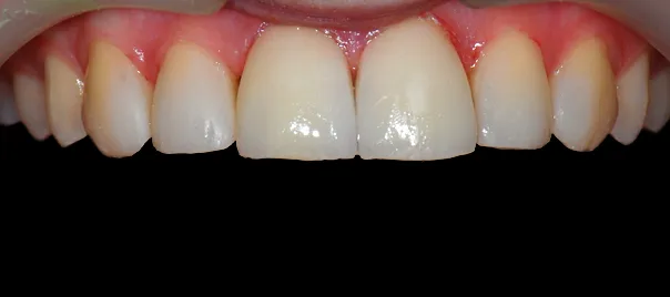 przestrzenie-miedzyzebowe-przed-leczeniem-prawy-profil-wichlinscy-stomatologia