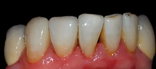 zamkniecie-przestrzeni-miedzyzebowych-kompozytem-dolny-luk-wichlinscy-stomatologia