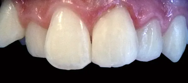 zlamany-zab-21-przed-odbudowa-wichlinscy-stomatologia