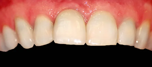 odbudowa-zeba-11-korona-na-implancie-wichlinscy-stomatologia