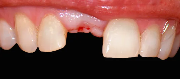 brak-zeba-11-po-ekstrakcji-przed-implantem-wichlinscy-stomatologia