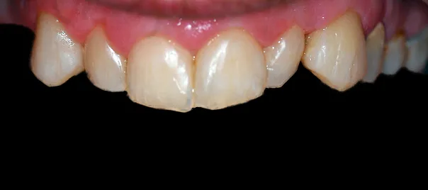 odbudowa-zebow-po-prochnicy-kompozyt-i-mikrochirurgia-wichlinscy-stomatologia