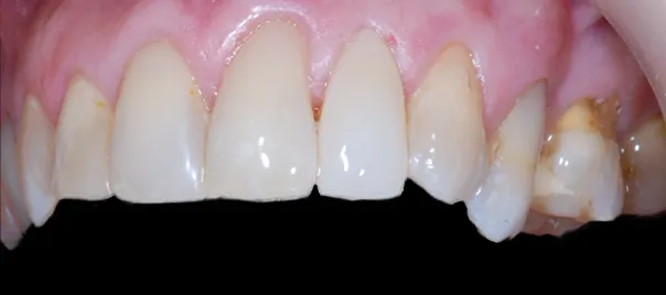 odbudowa-zeba-22-kompozyt-wlokno-szklane-wichlinscy-stomatologia