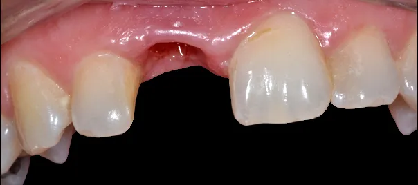 brak-zeba-przed-leczeniem-implantologicznym-wichlinscy-stomatologia