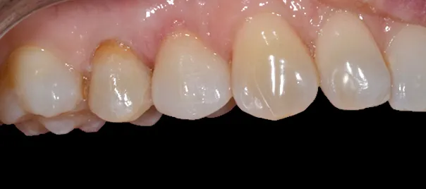 implantokorona-pelnoceramiczna-po-leczeniu-implantologicznym-wichlinscy-stomatologia