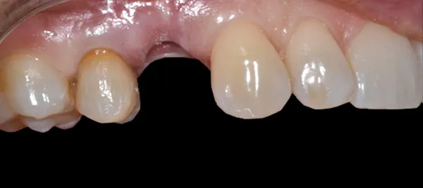 brak-zeba-bocznego-przed-implantem-wichlinscy-stomatologia