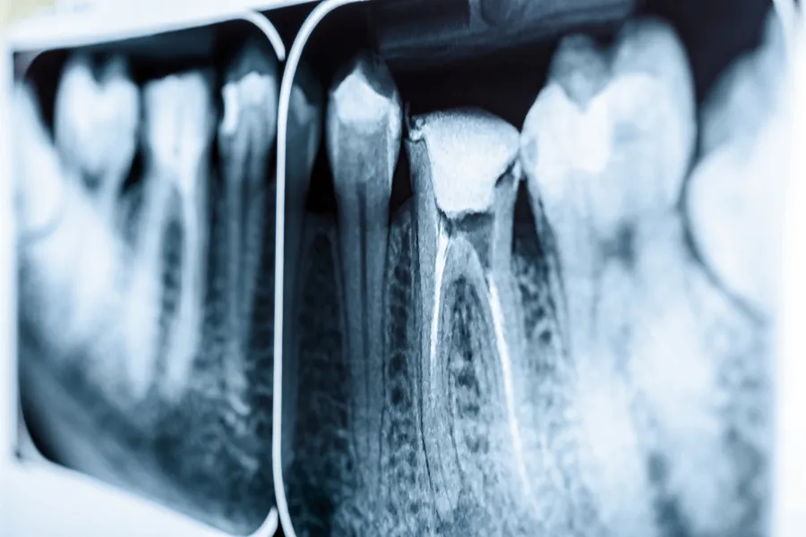 diagnostyka-bolu-zeba-po-endodoncji