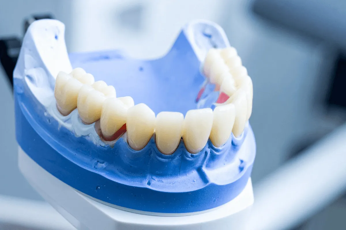 estetyka-uzebienia-proteza-na-implantach-model