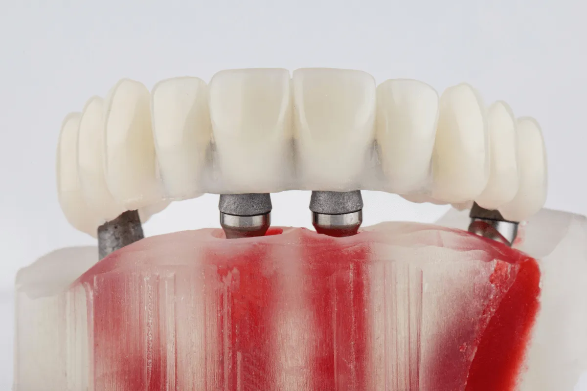 all-on-4-odbudowa-pelnego-luku