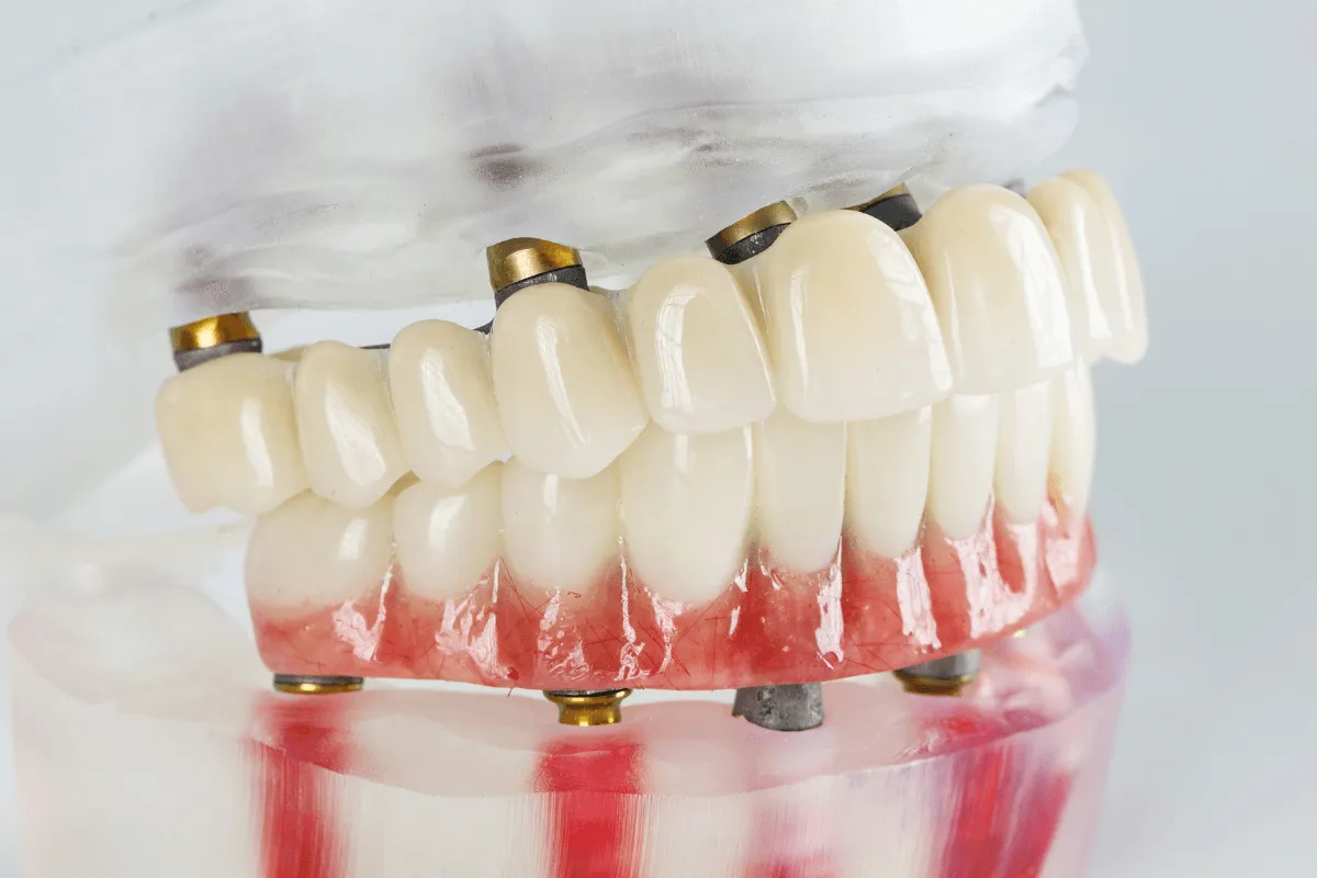 pelna-odbudowa-uzebienia-na-implantach