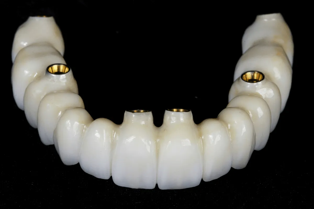 projekt-protezy-na-implantach-model