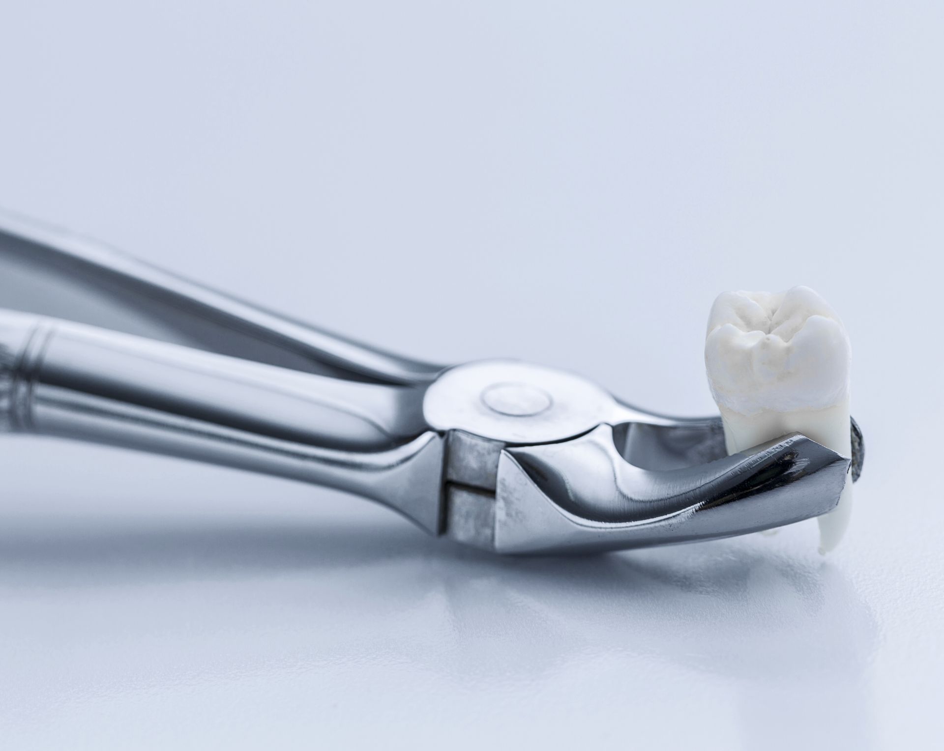 Extraction des dents de sagesse