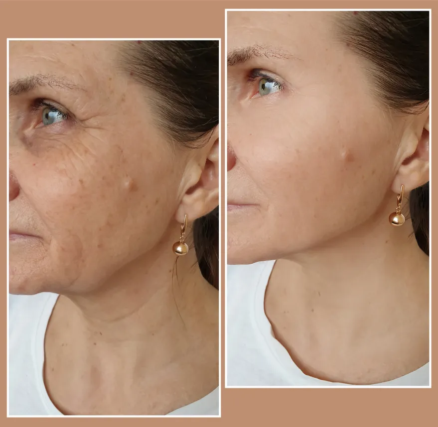 Renovaré MedSpa: Microneedling with Radiofrequency Treatment
