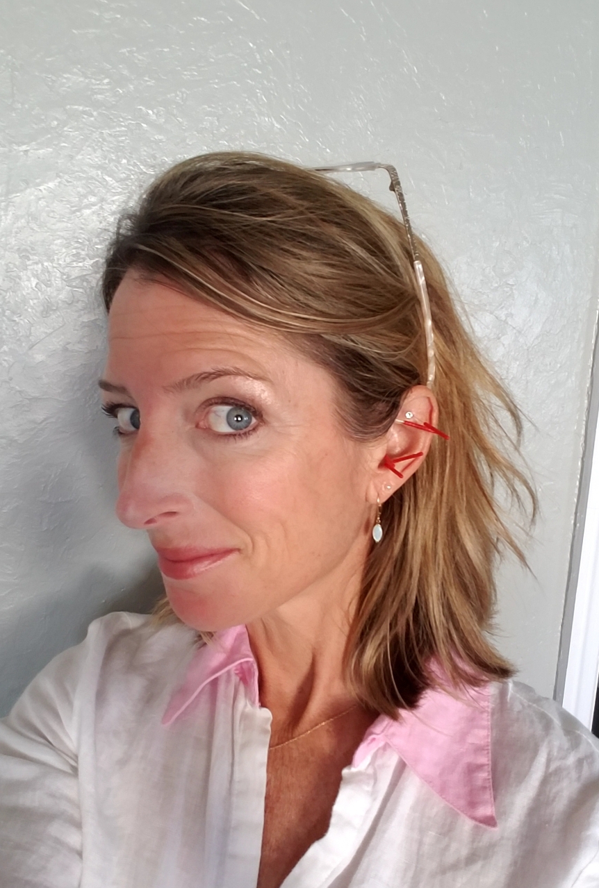 Dr. Sarah with acupuncture needles in her ear.
