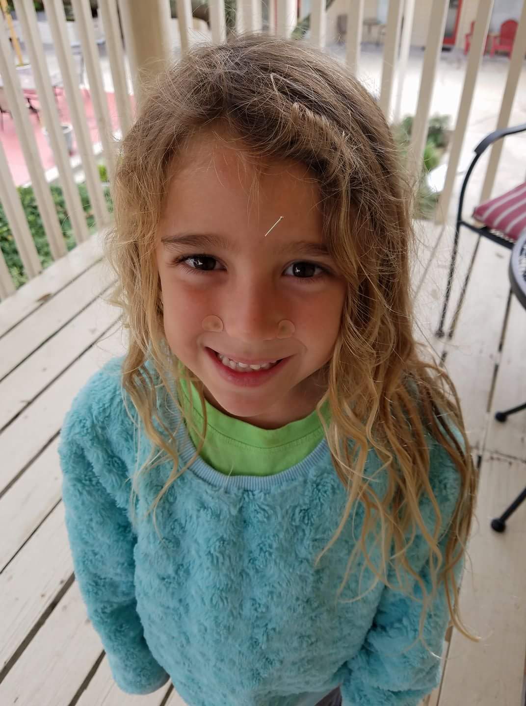 A little girl with an acupuncture needle on her forehead.