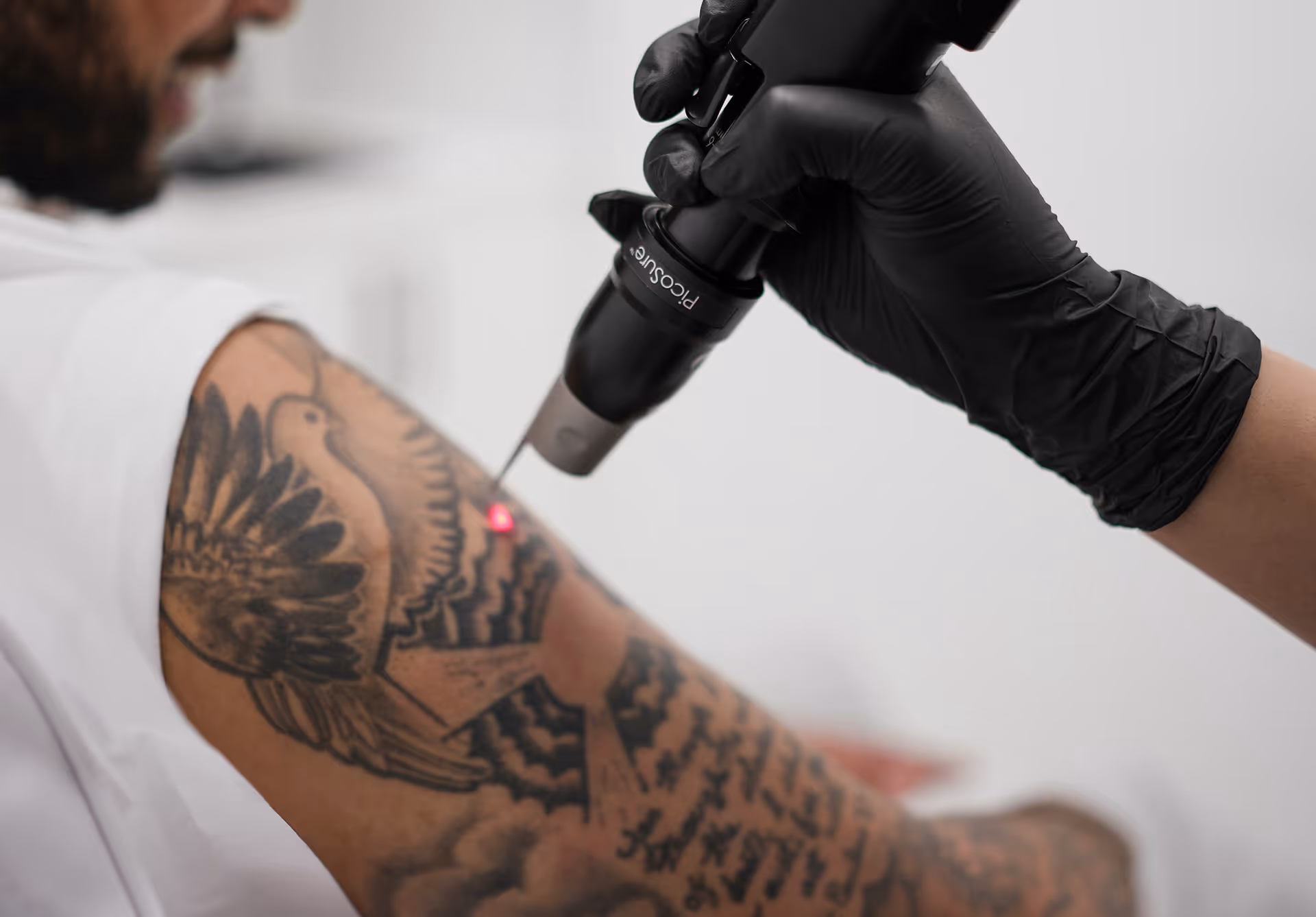 Laser Tattoo Removal