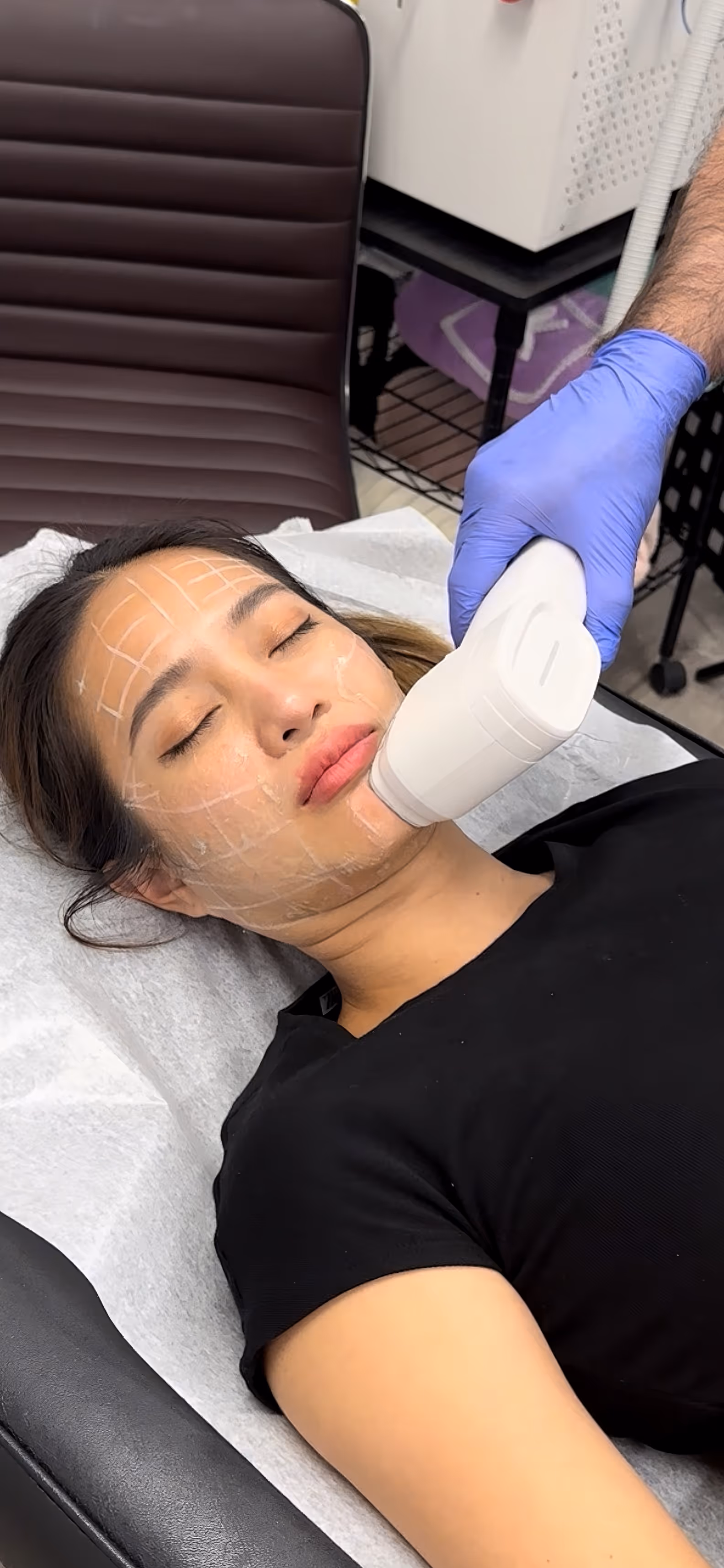 HIFU (High Intensity Focused Ultrasound)