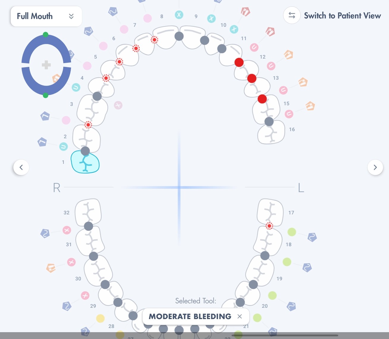 BOB dental chart: each interdental space coloured by brush size, with bleeding points marked