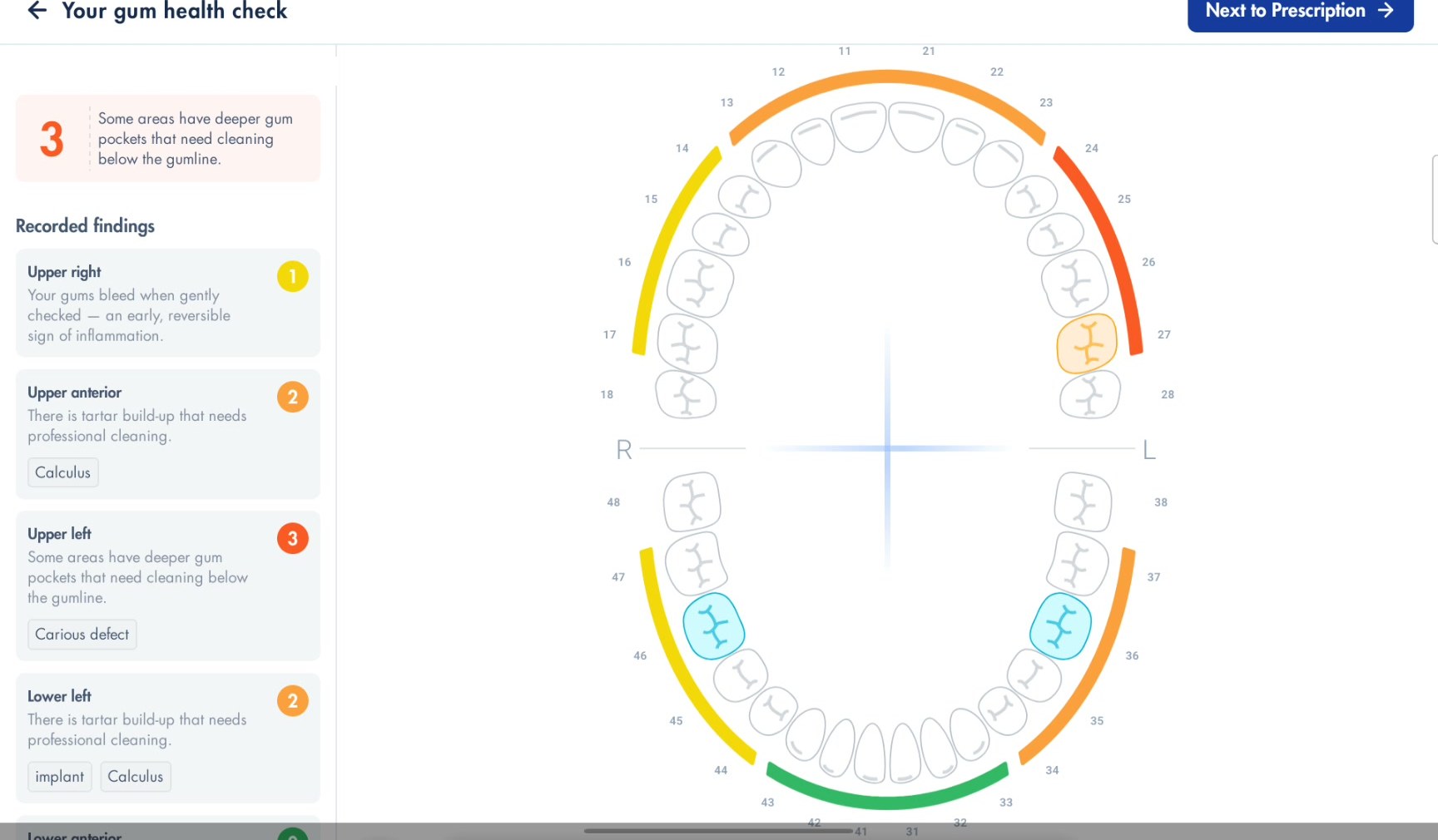 Your gum health check: sextant findings in plain language next to a colour-coded chart