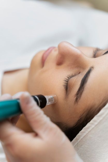 SkinNeedle Individual – Microneedling 