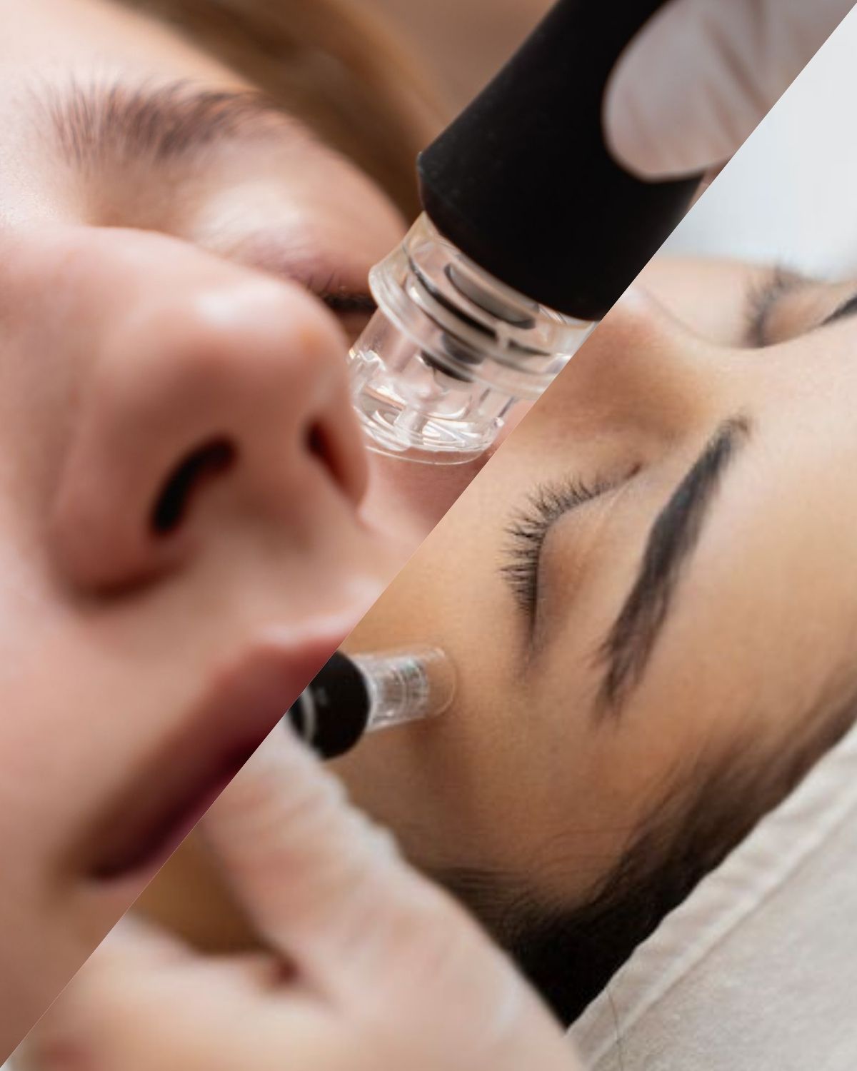 AQUA FACIAL x MICRONEEDLING – Tiefenreinigung, Regeneration & Glow