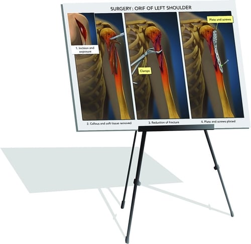 Surgical diagram displayed on a tripod easel showing steps of ORIF surgery for left shoulder fracture, including incision, removal of callous, fracture reduction, and placement of plate and screws.