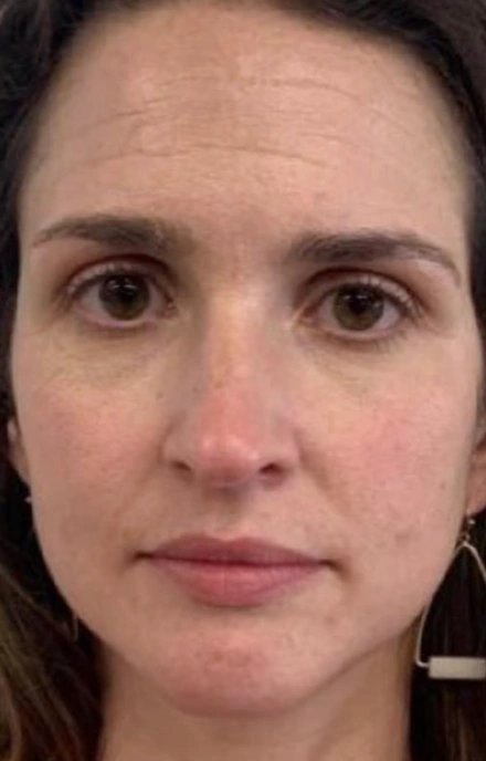 photo of individual before tox