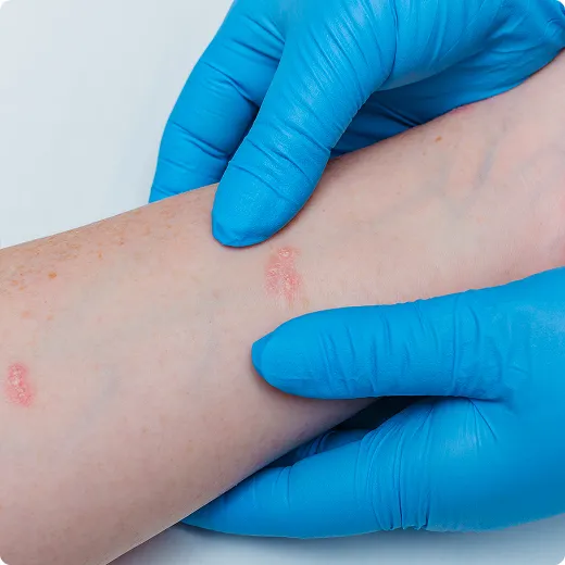 SmartCare Rx Pharmacy healthcare professional examining a patient’s skin rash or eczema patches, emphasizing dermatological care and support