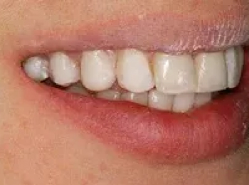 Perfect Smile Studio - Smile Makeover