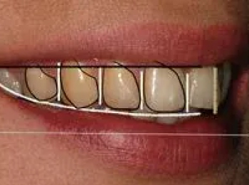 Perfect Smile Studio - Smile Makeover