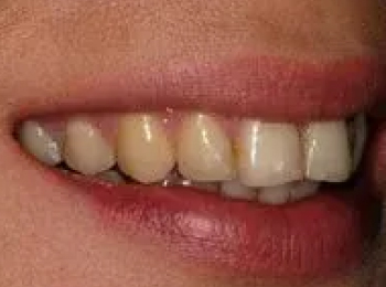 Perfect Smile Studio - Smile Makeover