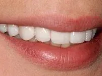 Perfect Smile Studio - Smile Makeover