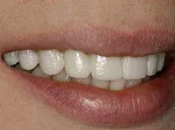 Perfect Smile Studio - Smile Makeover