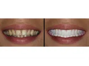 Perfect Smile Studio - Smile Makeover