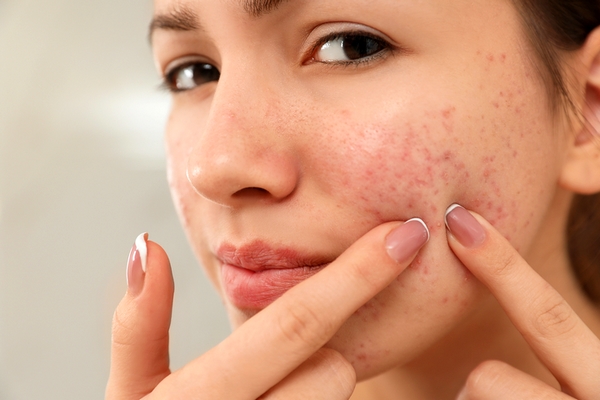 10 Home Remedies to Get Rid of Redness on Face